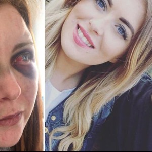 INSOLITE: Mon petit ami a essayé de m’arracher les yeux pour «que je sois si moche que personne ne veuille de moi»