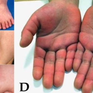 SANTE : Urgent : Kawasaki, un nouveau virus qui tue les enfants plus que le coronavirus